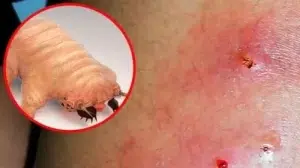 En Costa Rica muere mujer con diagnóstico de miasis por gusano barrenador